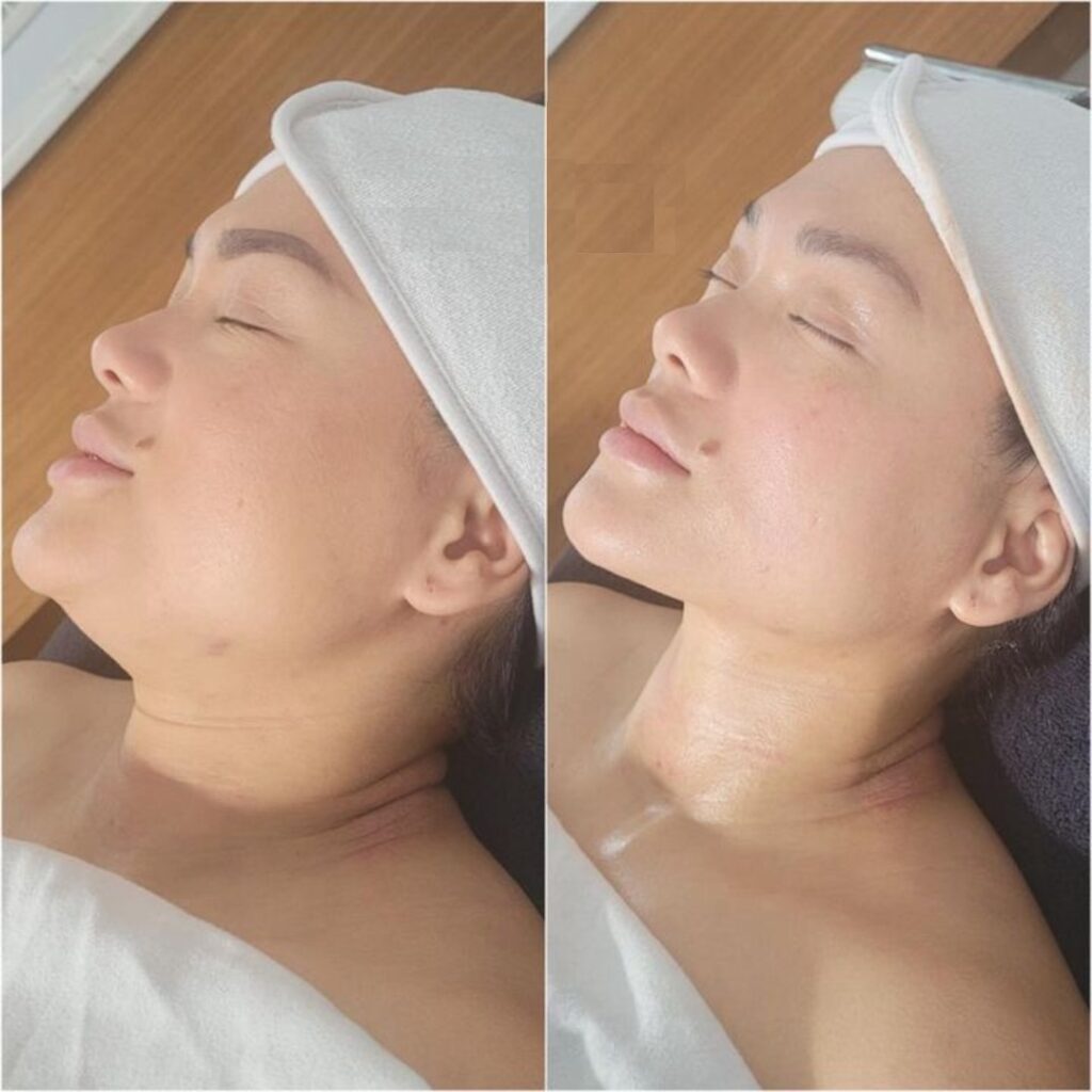 Buccal before and after (2)_1711663863